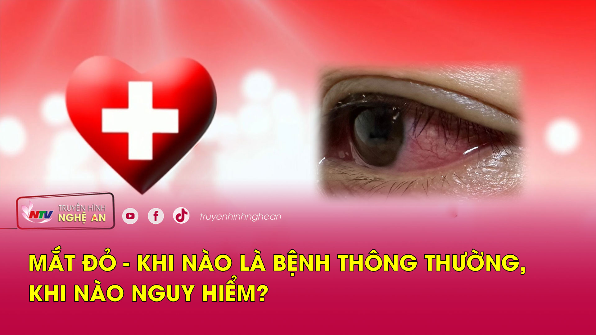 Sức khỏe của bạn: Mắt đỏ - Khi nào là bệnh thông thường, khi nào nguy hiểm?