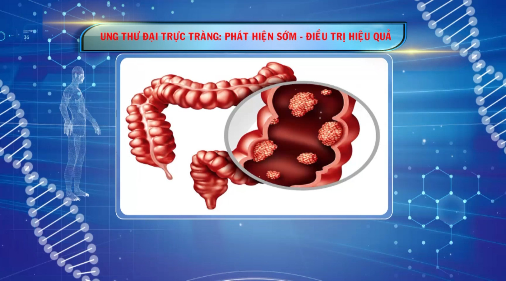 [🔴Trực tiếp] Sức khỏe của bạn: Ung thư đại trực tràng: Phát hiện sớm - Điều trị hiệu quả
