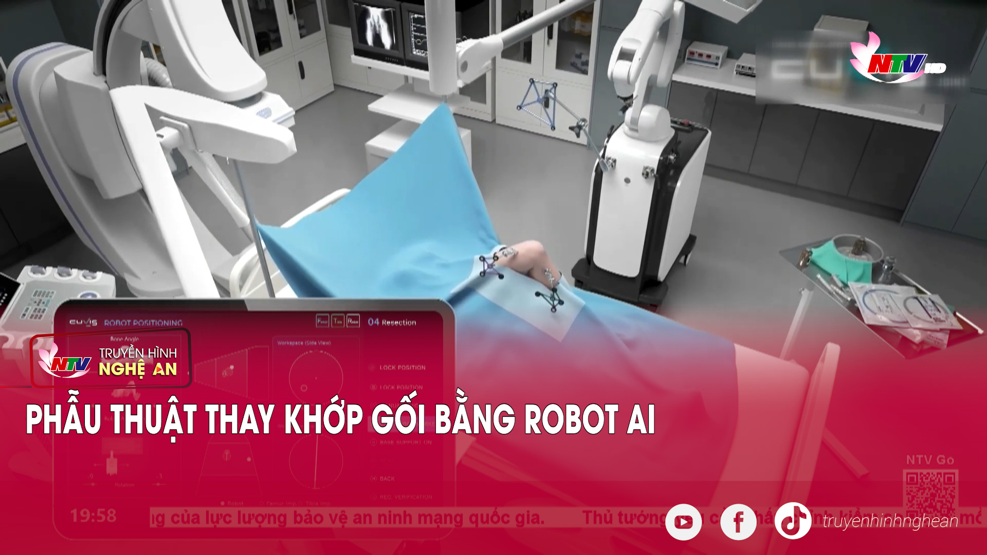 Phẫu thuật thay khớp gối bằng Robot AI