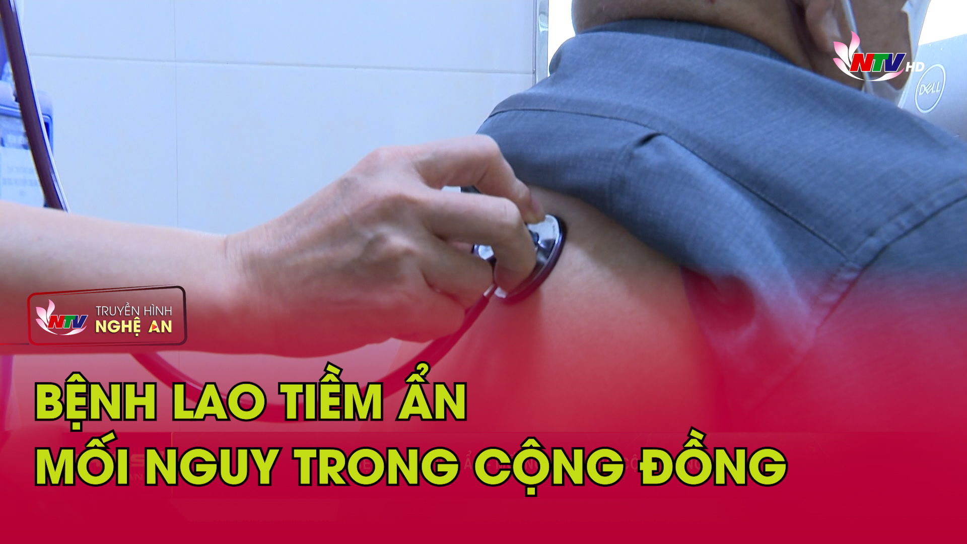 Bệnh Lao tiềm ẩn - Mối nguy trong cộng đồng